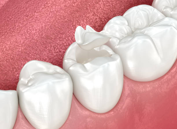 Best Dental Fillings (Composite and Amalgam)  in USA